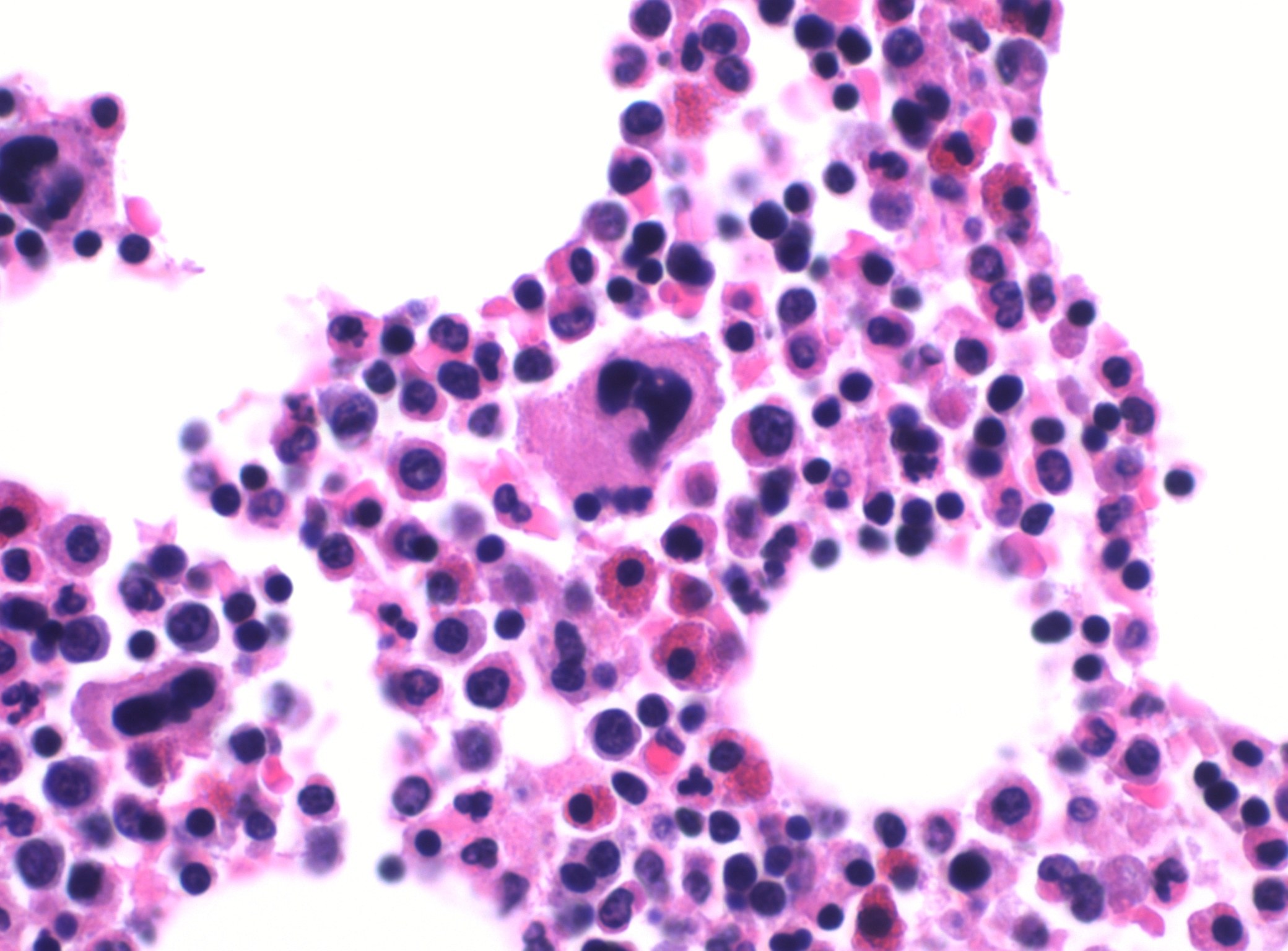 Mikroskopische Ansicht eines Blutausstrichs, der pink und lila gef├Ąrbte Lymphozytenzellen auf einem wei├čen Hintergrund zeigt.